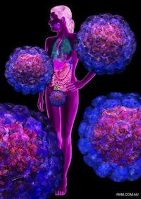 HPV and cervical cancer: courtesy Russell Kightley Media